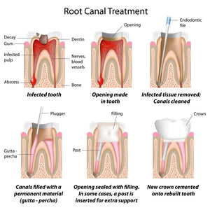 Dental - Root Canal (DER)